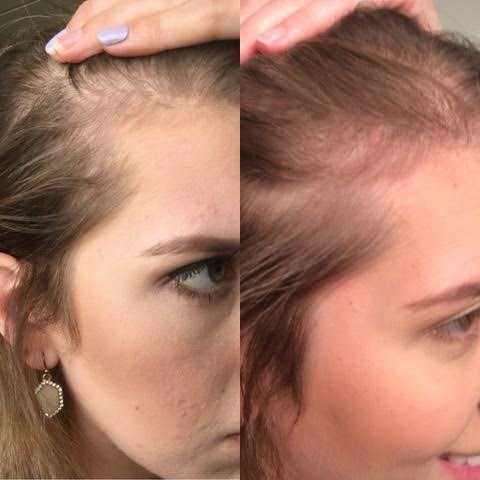 Выпадение волос летом: как с этим бороться? почему выпадают волосы?