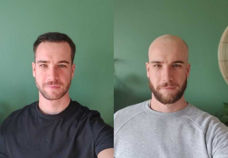 Алопеция на бороде у мужчин: лечение выпадения волос на бороде