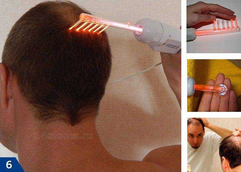 Физиотерапия для волос. восстановление волос лазером и током