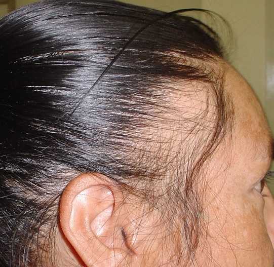 Волосы растущие от висков как называются