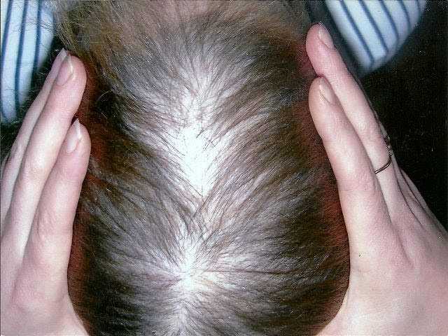 Миноксидил для роста волос: как использовать, противопоказания, отзывы