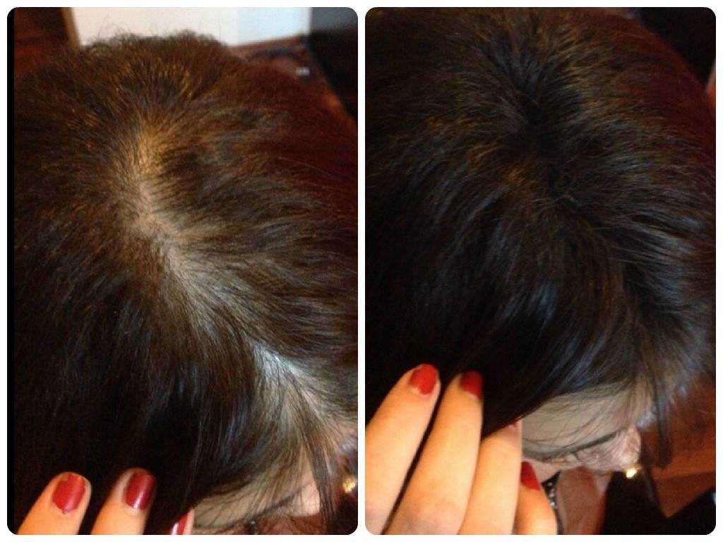 Гормональное выпадение волос у женщин 42-45 лет лечение что делать