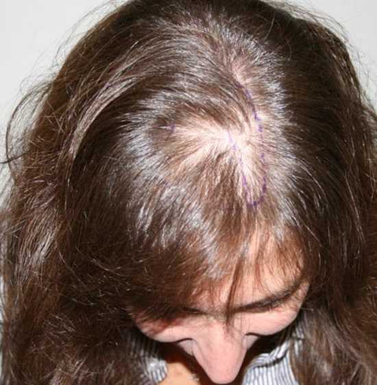 Преждевременное поседение волос. основные причины