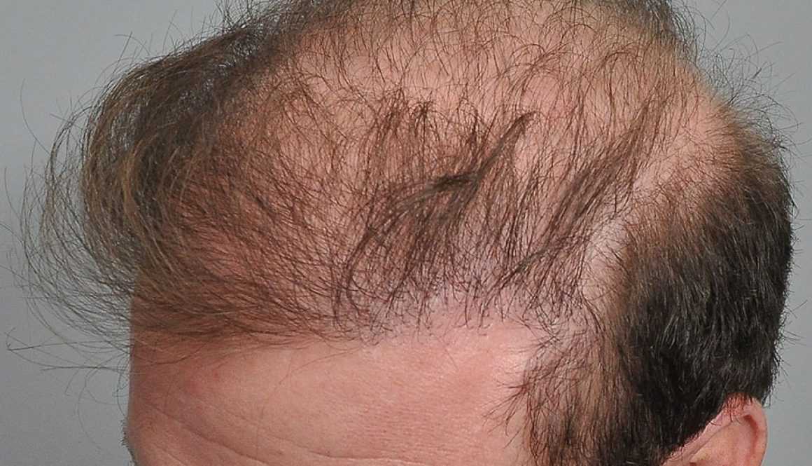 К какому врачу обращаться при выпадении волос?