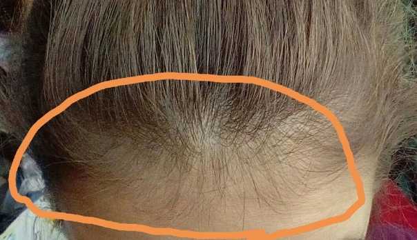 Мужской организм – потемки: почему волосы на голове выпадают, а на лице - растут?