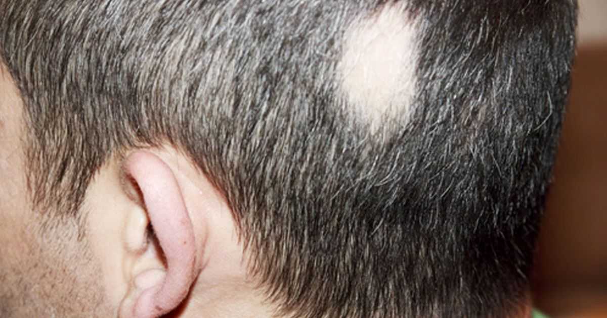 Алопеция на бороде у мужчин: лечение выпадения волос на бороде