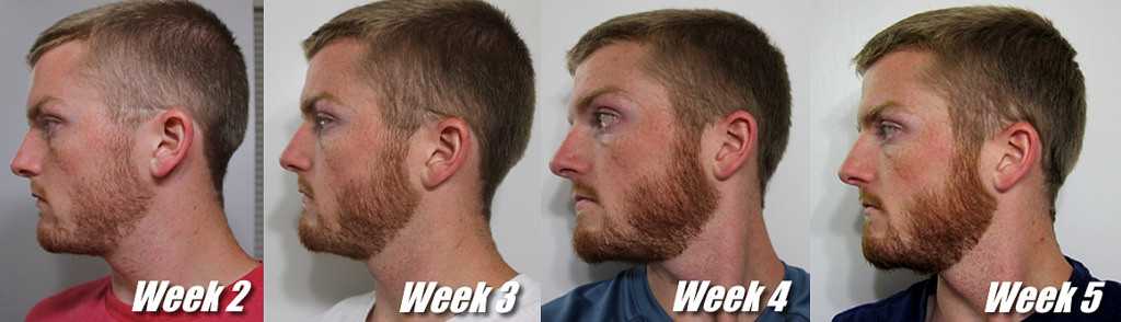 Что влияет на рост волос на лице у мужчин