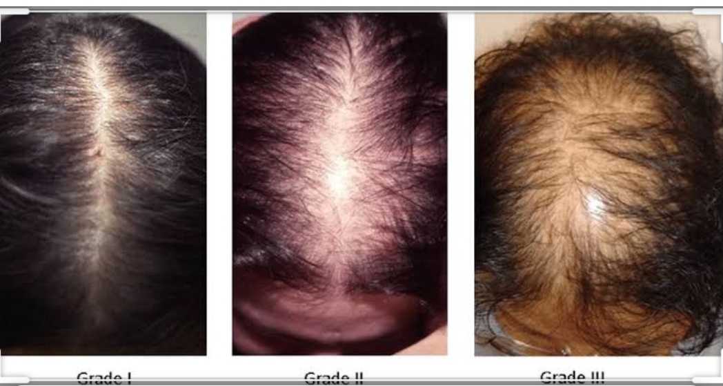 Влияние химической завивки на выпадение волос