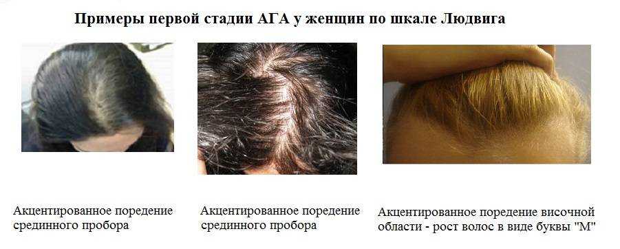 Крапива от выпадения волос:  рецепты и маски из крапивы для лечения выпадения волос на голове