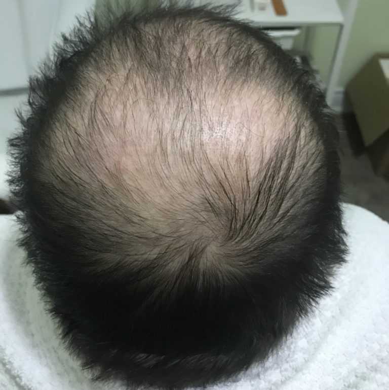 Тракционная алопеция. лечение тракционного выпадения волос