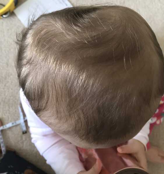 Выпадают волосы 4 месяц. Затылочная плагиоцефалия. Затылочная плагиоцефалия у детей. Позиционная плагиоцефалия.
