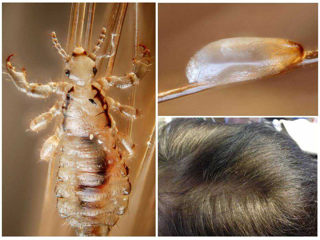 Как избавиться от гнид: как вывести на длинных волосах, как убрать сухие и мертвые гниды, удалить и убить быстро, как бороться с паразитами на голове, как лечить