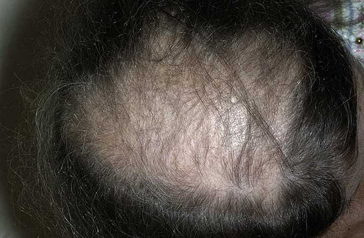 Выпадение волос в результате возникновения рубцов