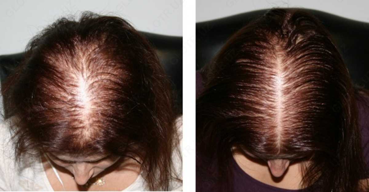 Волшебный укольчик: мезотерапия для волос