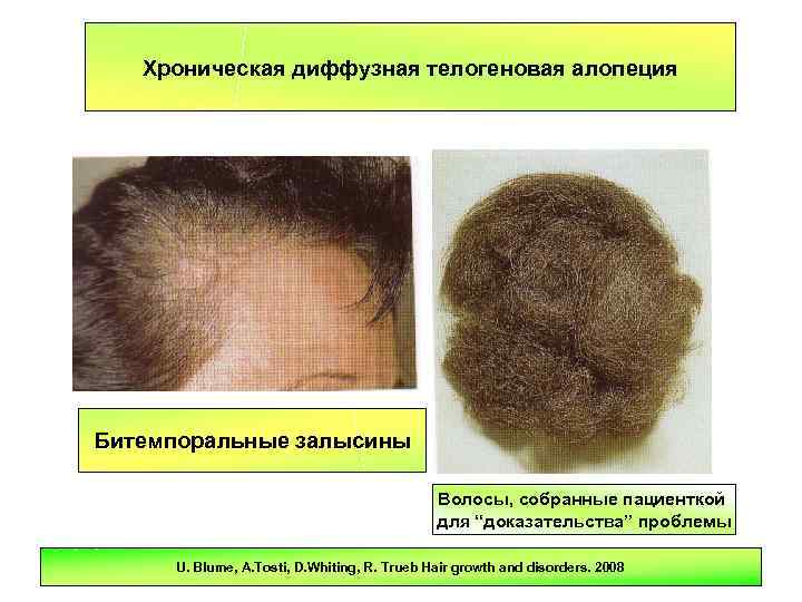 Врач гончарова татьяна: аутоиммунная алопеция - клиника «доктор волос»