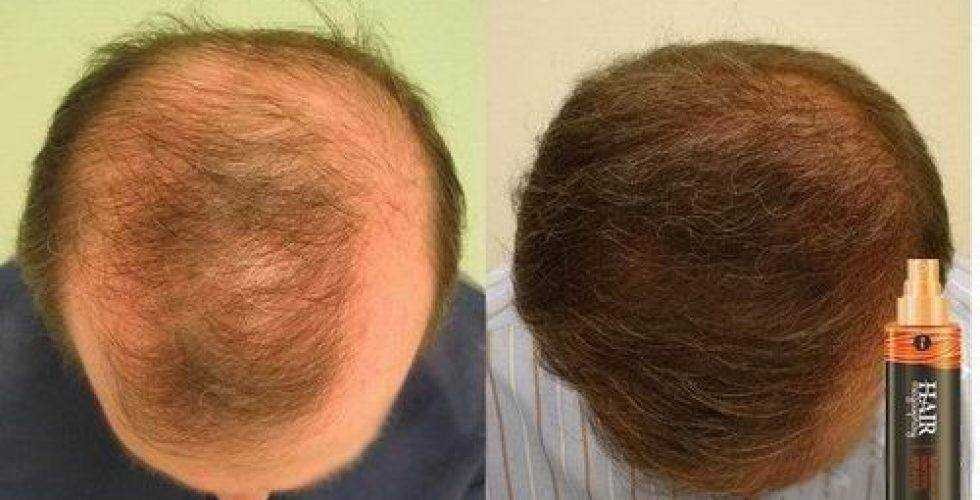 Гормональная алопеция, как основной фактор выпадения волос