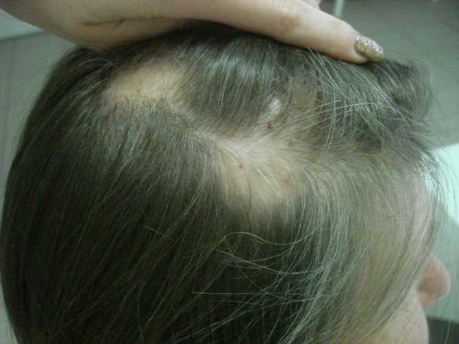 Что такое психосоматика выпадения волос Может ли быть причиной алопеции стресс Как диагностировать проблему Лечение облысения Методика Луизы Хей