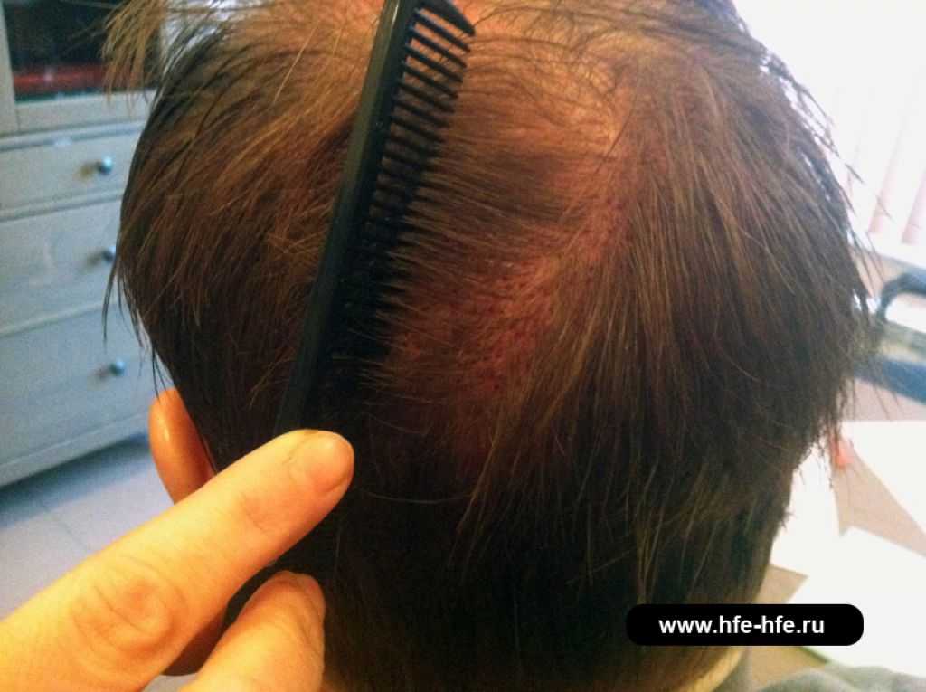 Выпадение волос у женщин в зрелом возрасте