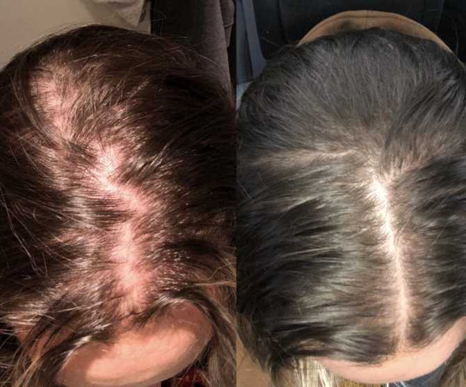 Барнаульский дерматолог рассказала о массивном выпадении волос после коронавируса