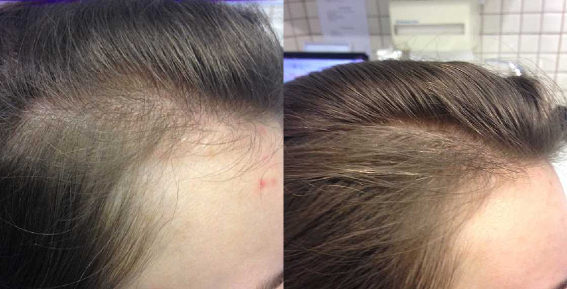 Могут выпадать волосы после йодотерапии