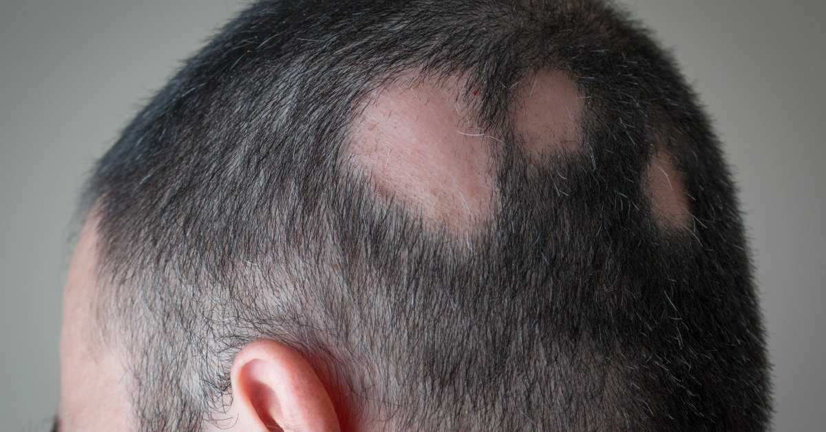 Как избежать выпадения волос?