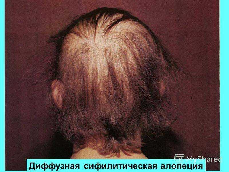 Седые волосы в раннем возрасте (в 16, 20, 25, 30 лет): причины у женщин и мужчин, когда начинают возникать, как бороться, лечение