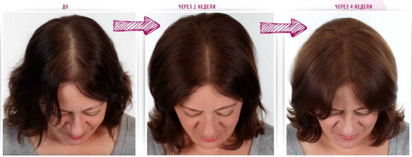 Рост волос с ultra hair system: реальные отзывы покупателей