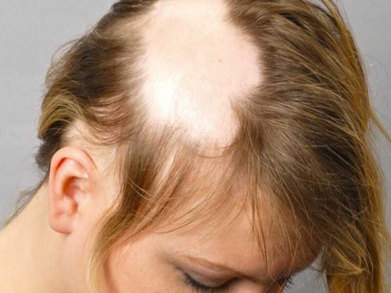 Выпадение волос на голове. причины частого выпадения волос