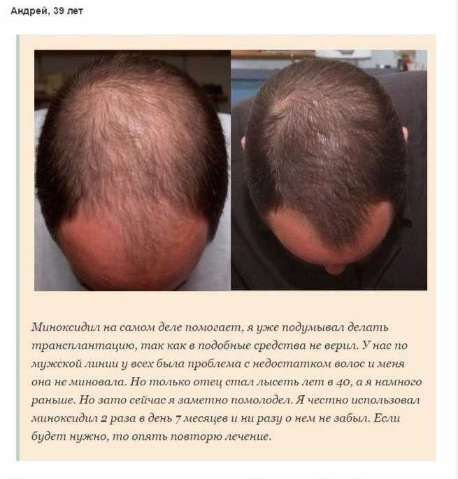 Асд для роста волос: можно ли применять этот препарат человеку | bellehair.info