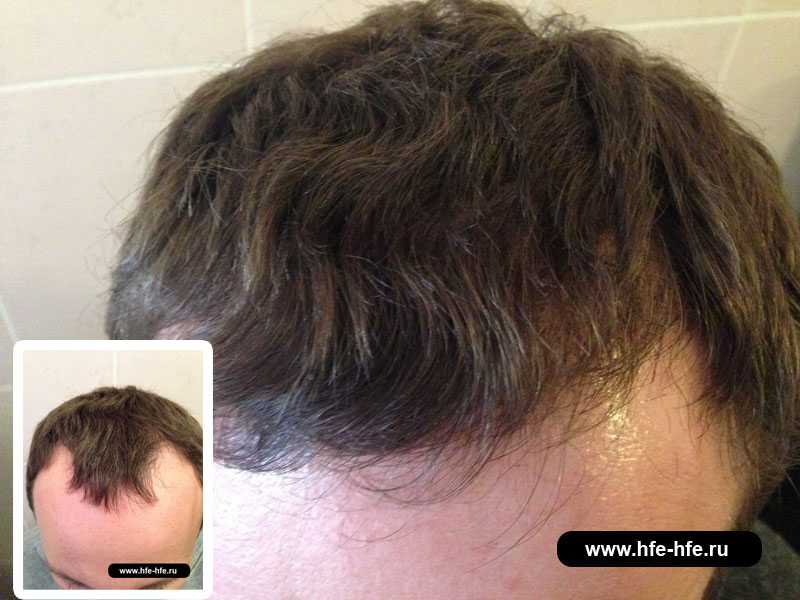 Факторы роста в лечении выпадения волос: настоящее и перспективы :: врачам-специалистам