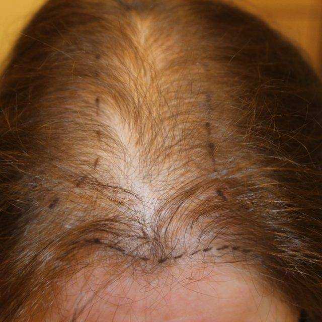 Выпадение волос: когда причины в голове