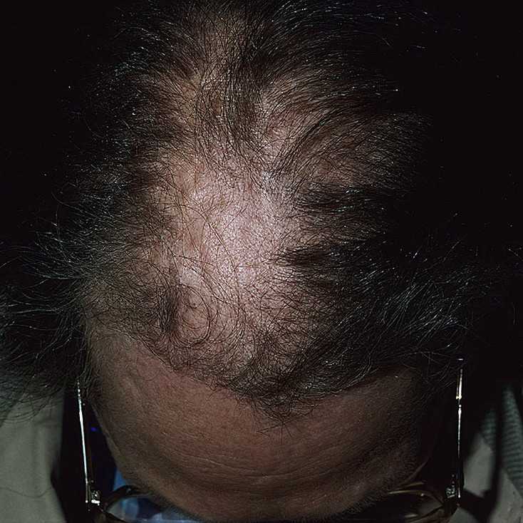 Препарат миноксидил предназначен для активного роста волос и остановки процесса облысения Это средство, прошедшее множество исследований, доказало свою невероятную эффективность