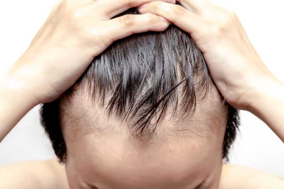 Определение степени потери волос у женщин