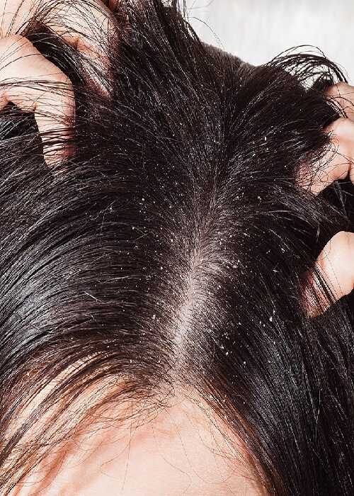 Грибок кожи головы – симптомы, лечение – как вылечить