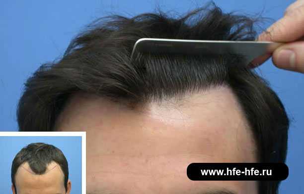 Холодное капсульное наращивание волос: какие бывают технологии, фото до и после, видео процедуры