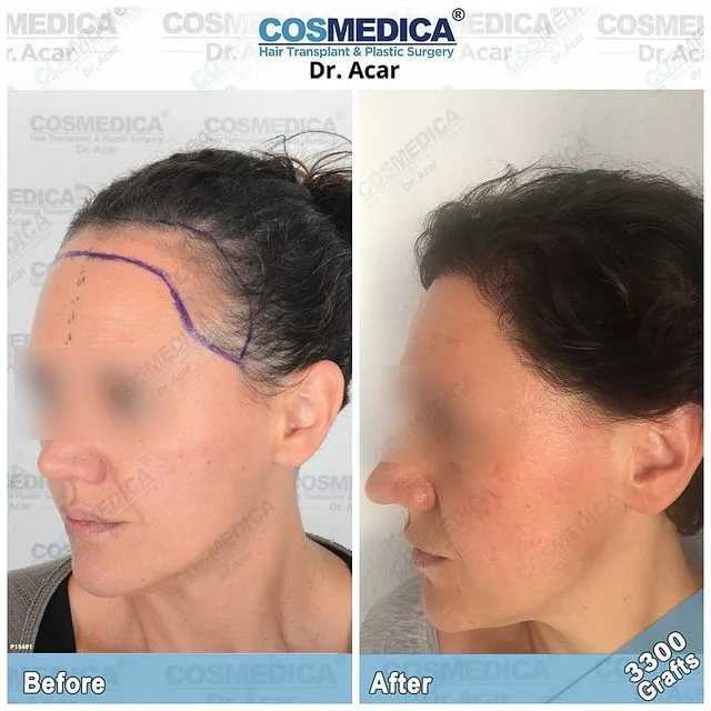 Пересадка волос на голову для женщин. клиника ренео