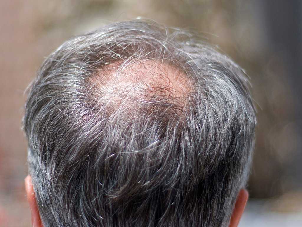 Почему волосы на голове седеют в раннем возрасте? причины возникновения преждевременной седины