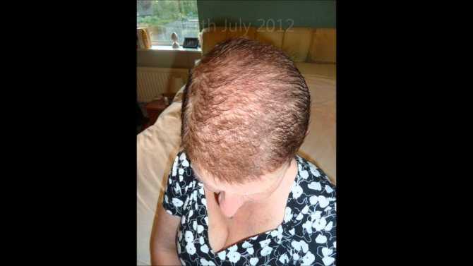 Причины выпадения волос после химиотерапии Всегда ли происходит облысение, как быстро и когда прическа начнет восстанавливаться Можно ли предотвратить Уход за волосами после лучевой терапии