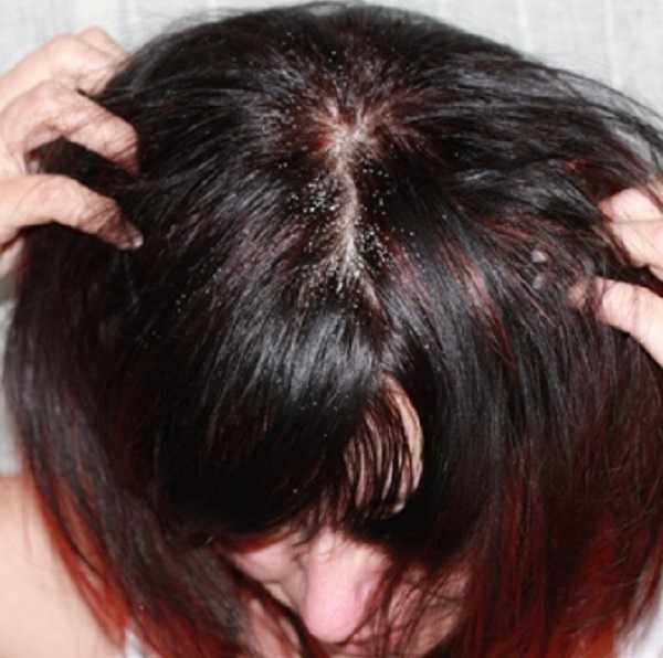 Себорея и выпадение волос - перхоть, зуд и выпадение волос - себорейный дерматит