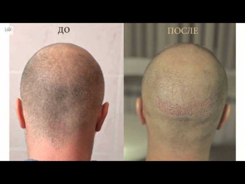 Как выглядит донорская зона после пересадки волос
