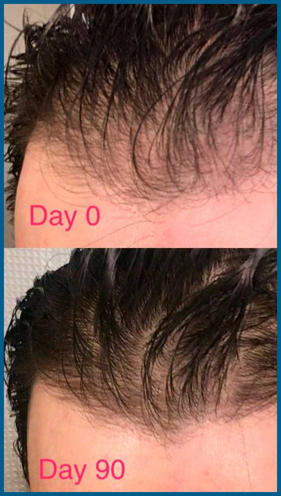 Медикаментозное лечение волос: миноксидил, регейн, финоксиди
