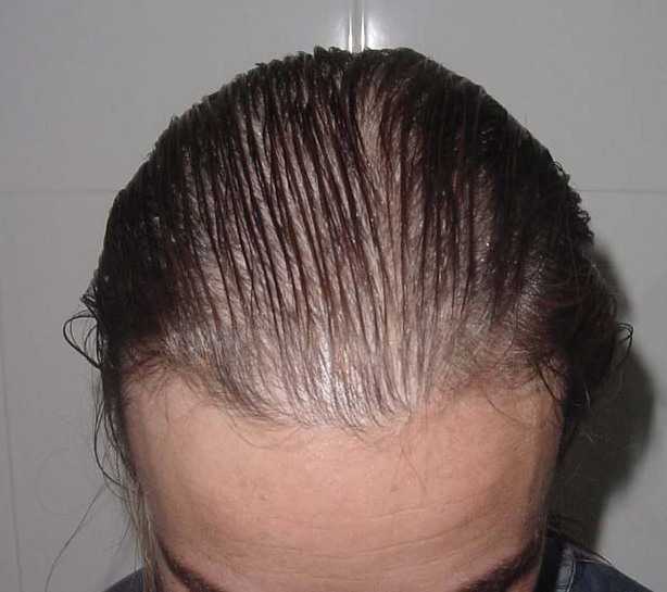 Сильное выпадение волос у женщин – публикации – лаборатория ан-тек