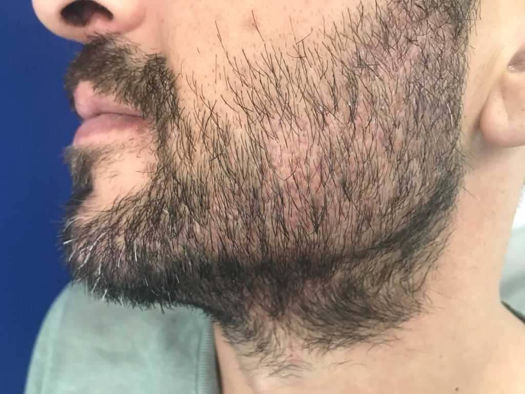 Как определить нижний контур бороды? - dorco.ru