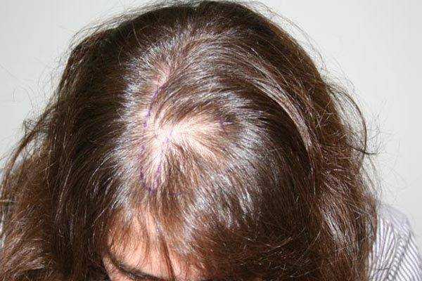 Медикаментозное лечение волос: миноксидил, регейн, финоксидил