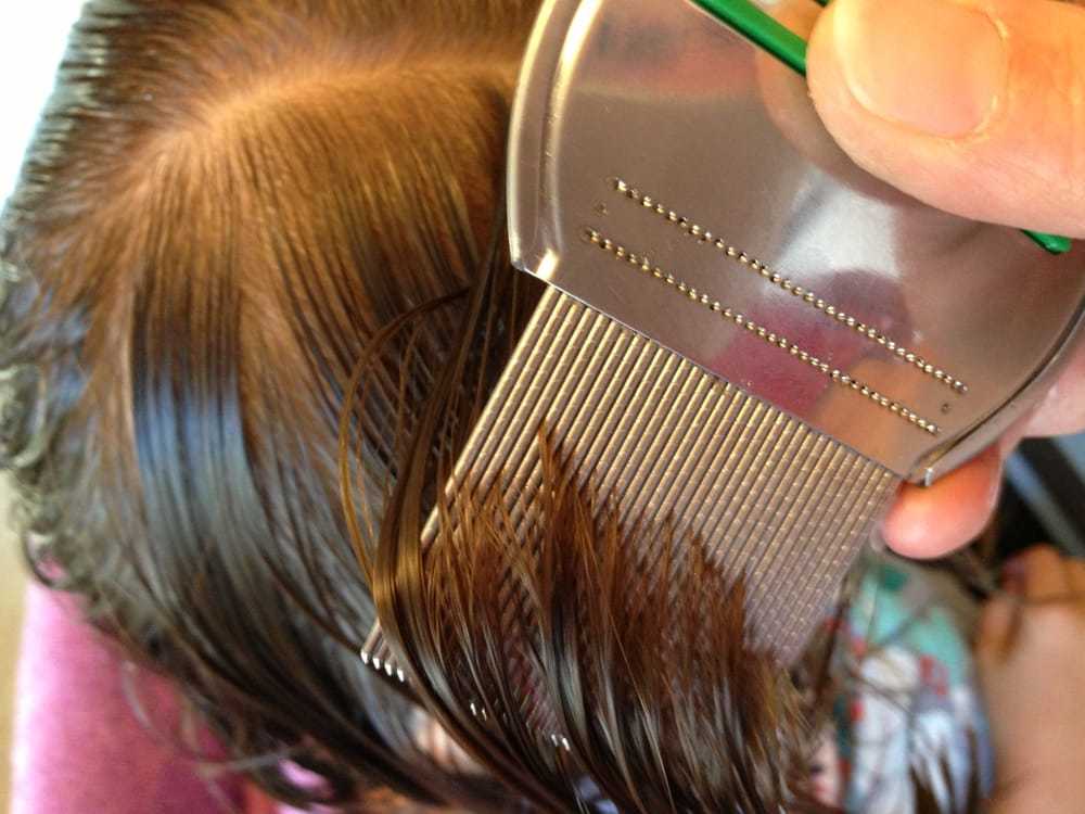 Как быстро избавиться от гнид на длинных волосах в домашних условиях за 1 день