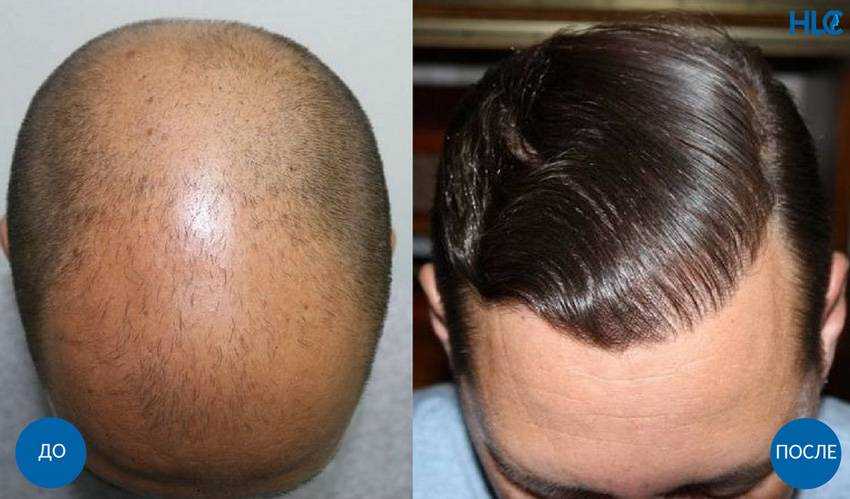Почему у человека волосы растут только на голове