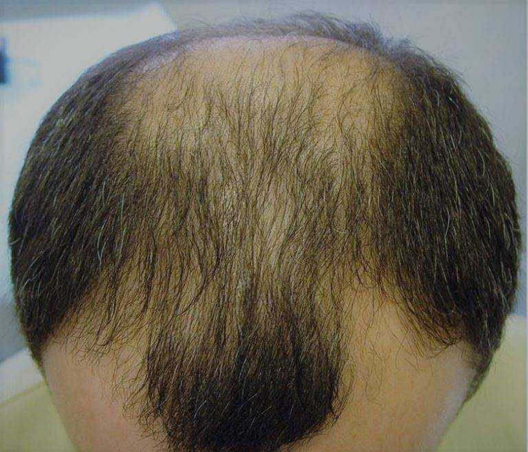 Начался «волосопад»: почему сильно сыпятся волосы