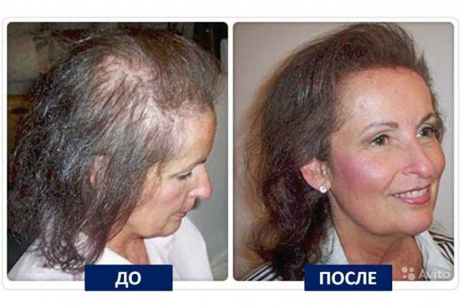 Маска Русское поле с красным перцем увеличивает рост волос, останавливает процесс выпадение и улучшает состояние шевелюры Доступная цена и высокий эффект принесли популярность среди пользователей
