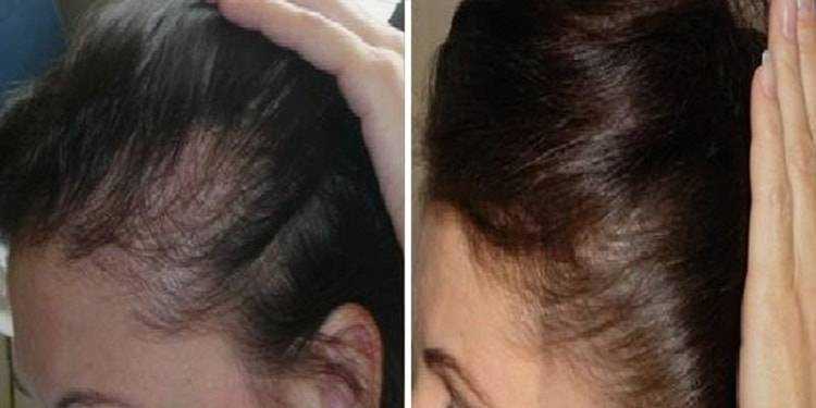 Лечение выпадения волос медикаментозными препаратами