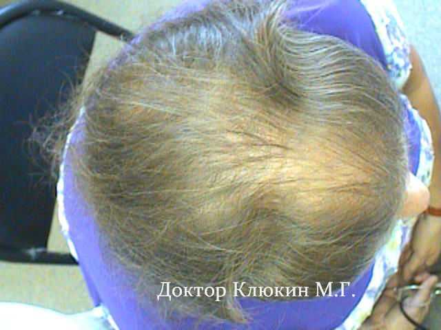 При каких заболеваниях происходит выпадение волос?